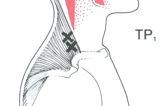 Trapezius Muscle Pain Illustration